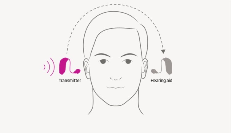 A Lumity hearing solution for unaidable hearing loss in one ear